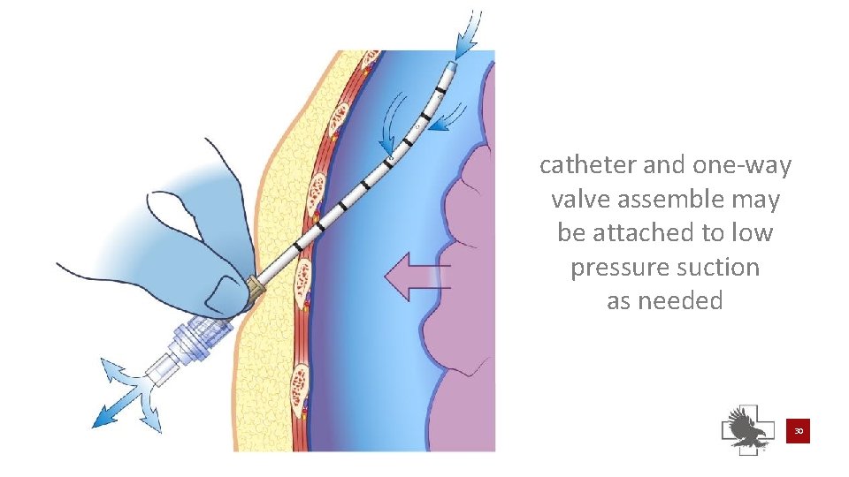 catheter and one-way valve assemble may be attached to low pressure suction as needed catheter and one-way valve assemble may be attached to low pressure suction as needed