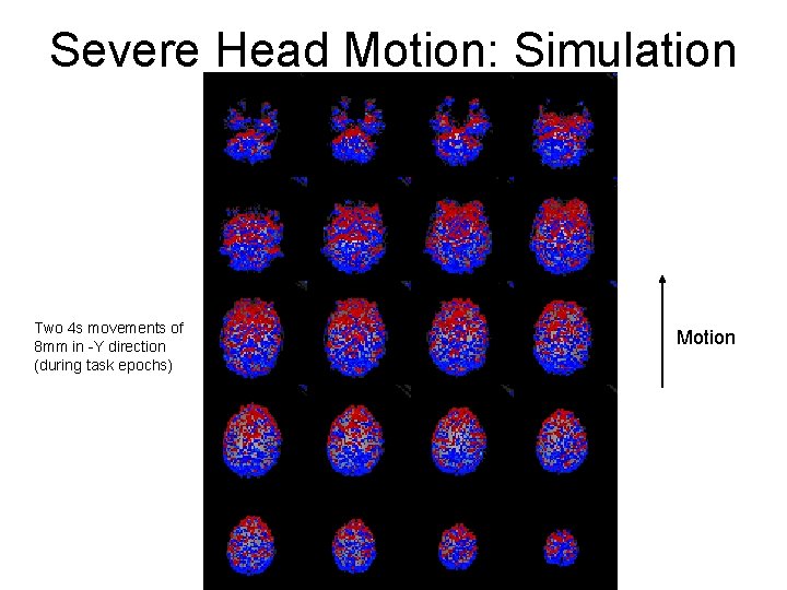 Severe Head Motion: Simulation Two 4 s movements of 8 mm in -Y direction