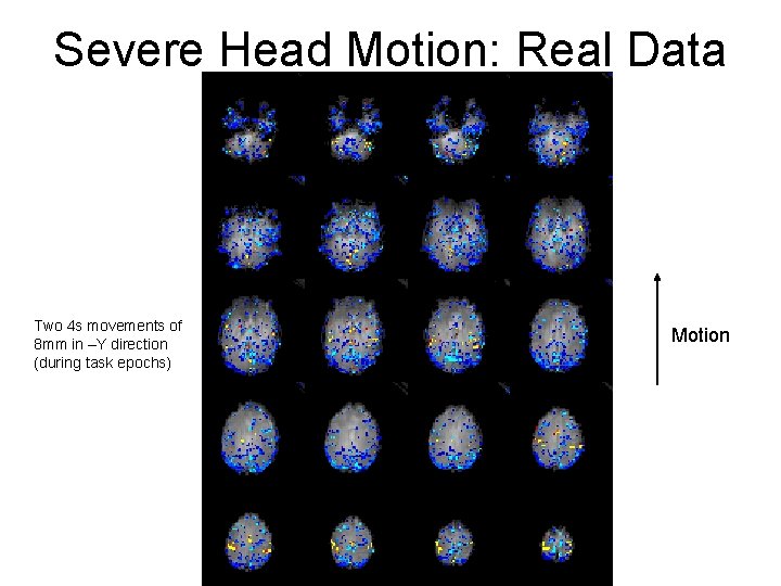 Severe Head Motion: Real Data Two 4 s movements of 8 mm in –Y