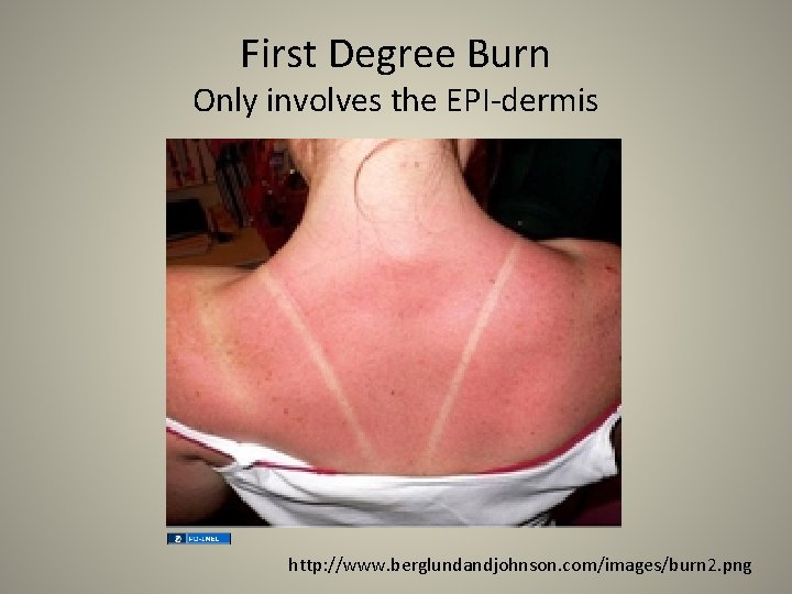 First Degree Burn Only involves the EPI-dermis http: //www. berglundandjohnson. com/images/burn 2. png 