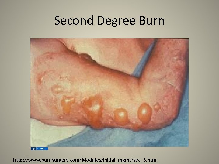 Second Degree Burn http: //www. burnsurgery. com/Modules/initial_mgmt/sec_5. htm 