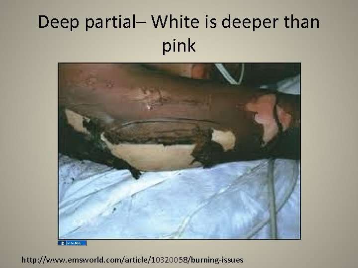 Deep partial– White is deeper than pink http: //www. emsworld. com/article/10320058/burning-issues 