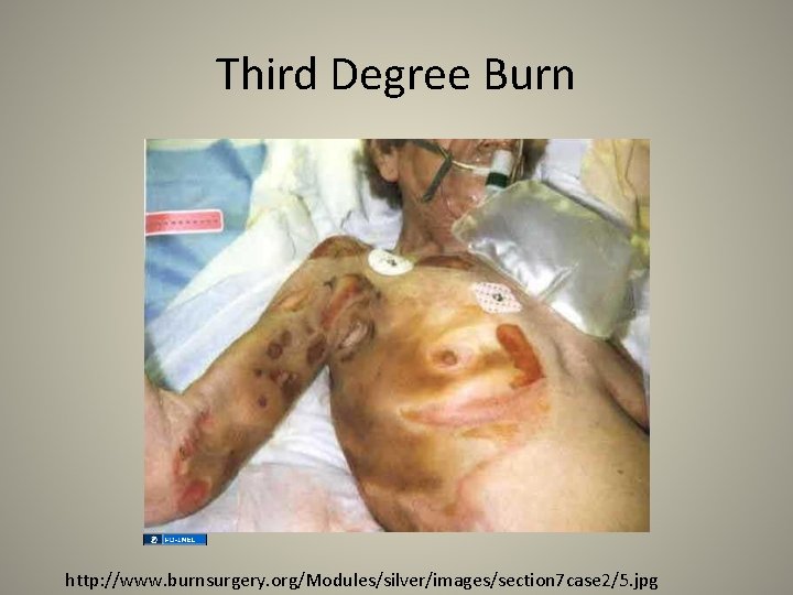 Third Degree Burn http: //www. burnsurgery. org/Modules/silver/images/section 7 case 2/5. jpg 