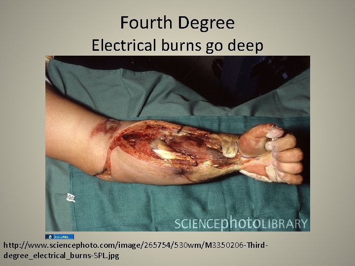 Fourth Degree Electrical burns go deep http: //www. sciencephoto. com/image/265754/530 wm/M 3350206 -Thirddegree_electrical_burns-SPL. jpg