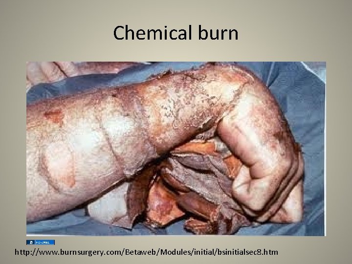 Chemical burn http: //www. burnsurgery. com/Betaweb/Modules/initial/bsinitialsec 8. htm 