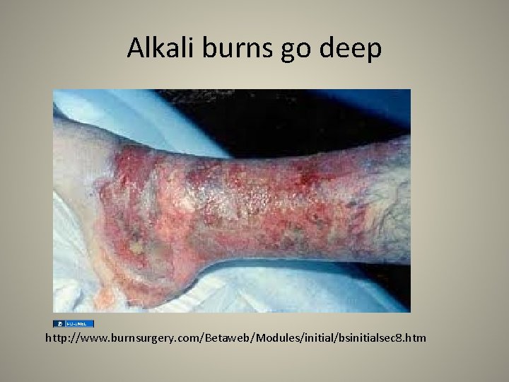 Alkali burns go deep http: //www. burnsurgery. com/Betaweb/Modules/initial/bsinitialsec 8. htm 