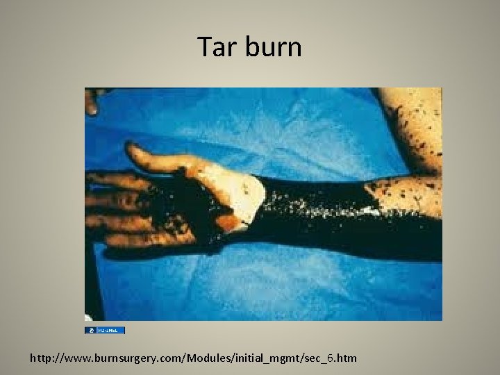 Tar burn http: //www. burnsurgery. com/Modules/initial_mgmt/sec_6. htm 