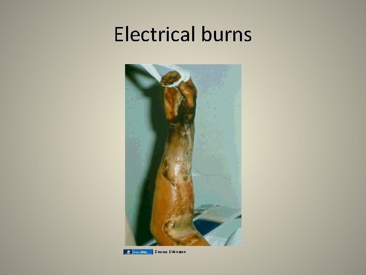 Electrical burns Source Unknown 