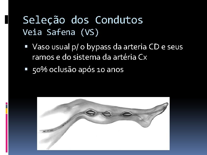 Seleção dos Condutos Veia Safena (VS) Vaso usual p/ o bypass da arteria CD