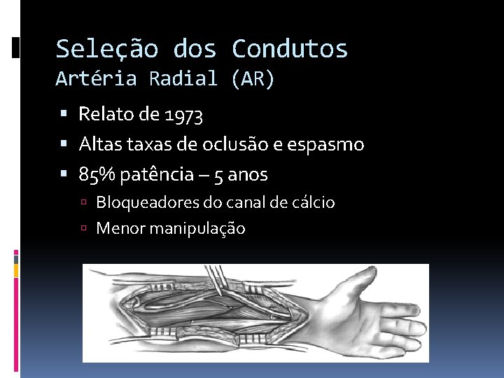 Seleção dos Condutos Artéria Radial (AR) Relato de 1973 Altas taxas de oclusão e