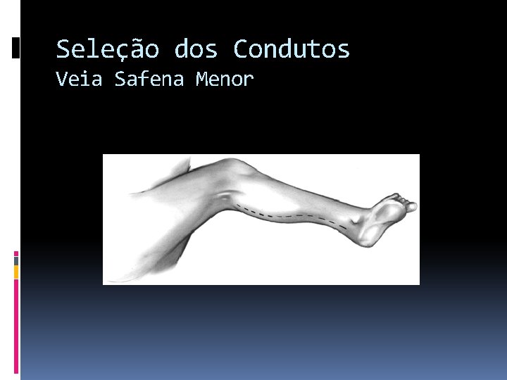 Seleção dos Condutos Veia Safena Menor 