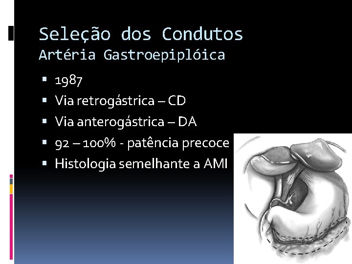 Seleção dos Condutos Artéria Gastroepiplóica 1987 Via retrogástrica – CD Via anterogástrica – DA