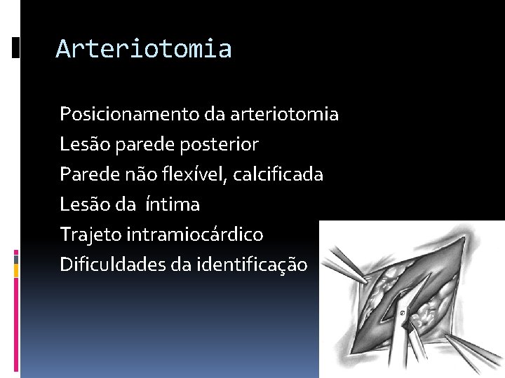 Arteriotomia Posicionamento da arteriotomia Lesão parede posterior Parede não flexível, calcificada Lesão da íntima