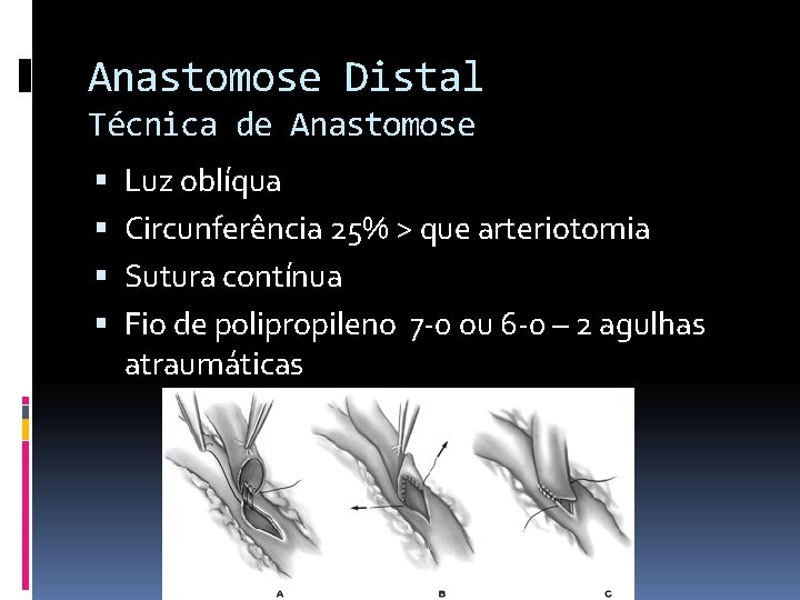 Anastomose Distal Técnica de Anastomose Luz oblíqua Circunferência 25% > que arteriotomia Sutura contínua