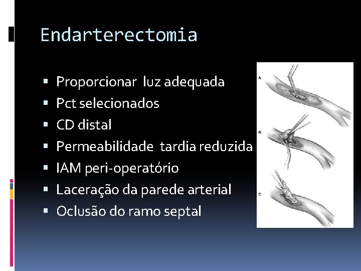 Endarterectomia Proporcionar luz adequada Pct selecionados CD distal Permeabilidade tardia reduzida IAM peri-operatório Laceração