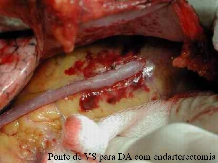 Ponte de VS para DA c/ endarterectomia Ponte de VS para DA com endarterectomia
