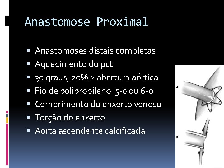 Anastomose Proximal Anastomoses distais completas Aquecimento do pct 30 graus, 20% > abertura aórtica