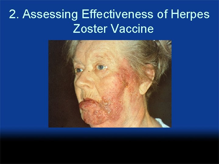 2. Assessing Effectiveness of Herpes Zoster Vaccine 