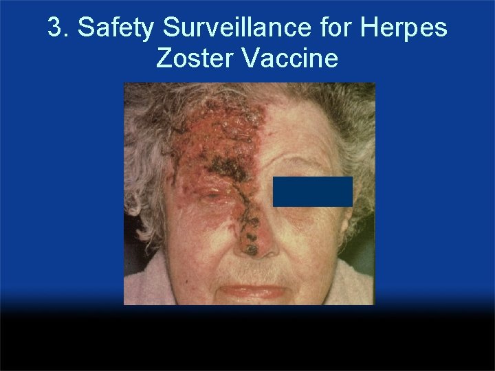 3. Safety Surveillance for Herpes Zoster Vaccine 