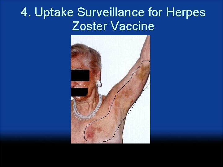 4. Uptake Surveillance for Herpes Zoster Vaccine 