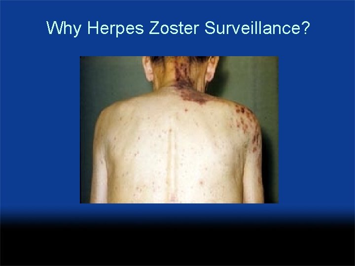Why Herpes Zoster Surveillance? 