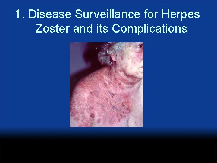 1. Disease Surveillance for Herpes Zoster and its Complications 