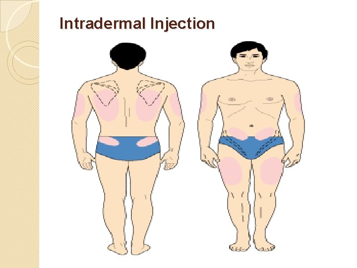 Intradermal Injection 