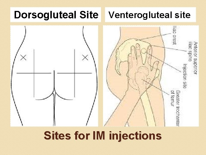 Dorsogluteal Site Venterogluteal site Sites for IM injections 