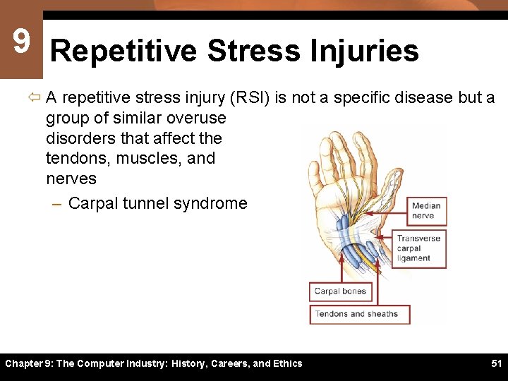 9 Repetitive Stress Injuries ï A repetitive stress injury (RSI) is not a specific