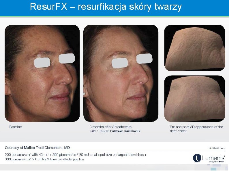 Resur. FX – resurfikacja skóry twarzy 