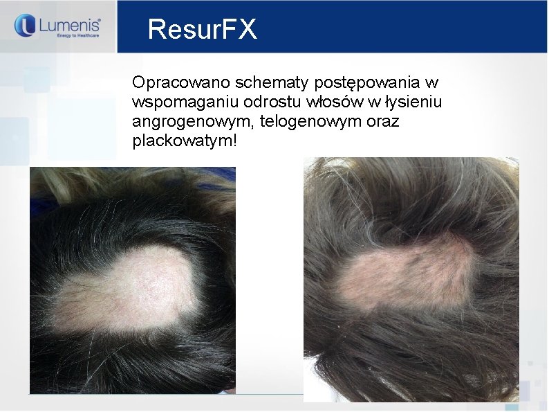 Resur. FX Opracowano schematy postępowania w wspomaganiu odrostu włosów w łysieniu angrogenowym, telogenowym oraz