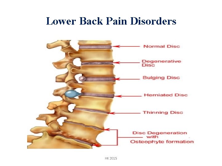 Lower Back Pain Disorders HK 2015 