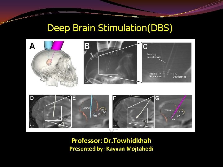 Deep Brain Stimulation(DBS) Professor: Dr. Towhidkhah Presented by: Kayvan Mojtahedi 