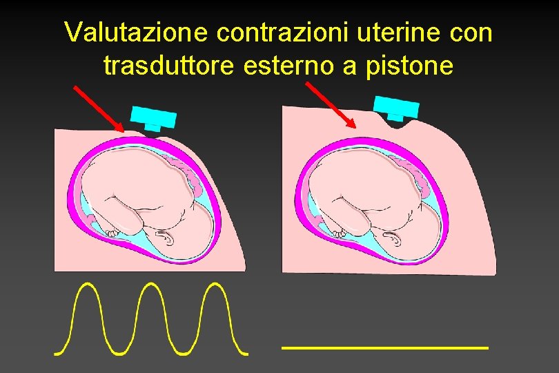 Valutazione contrazioni uterine con trasduttore esterno a pistone 