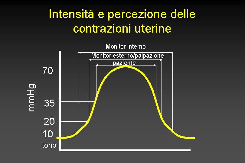 Intensità e percezione delle contrazioni uterine mm. Hg 70 35 20 10 tono Monitor