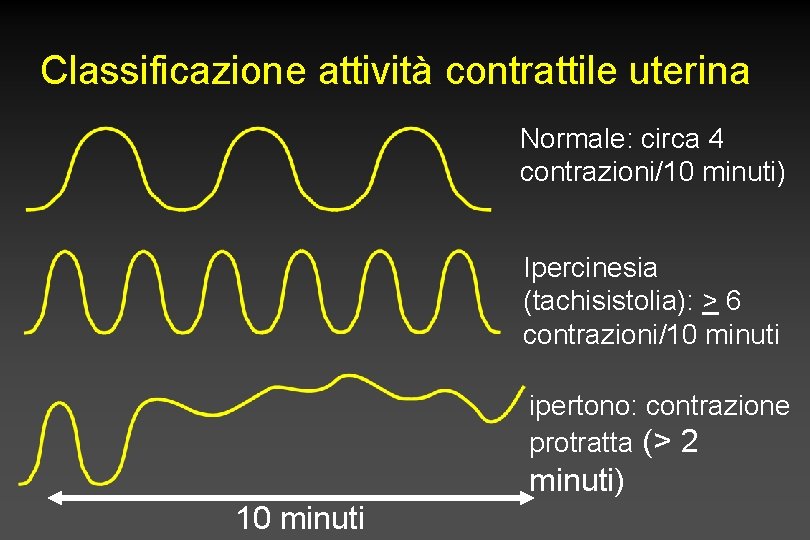 Classificazione attività contrattile uterina Normale: circa 4 contrazioni/10 minuti) Ipercinesia (tachisistolia): > 6 contrazioni/10