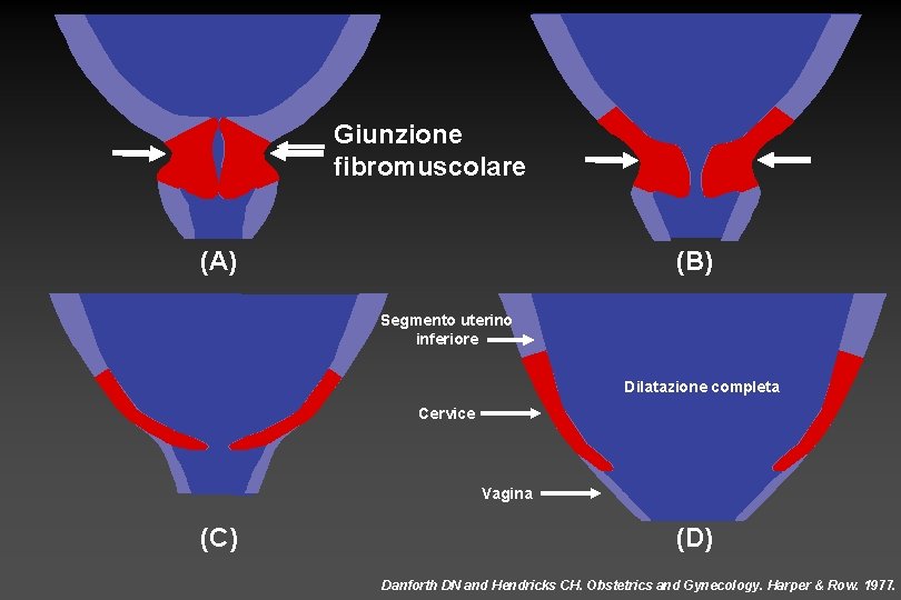 Giunzione fibromuscolare (A) (B) Segmento uterino inferiore Dilatazione completa Cervice Vagina (C) (D) Danforth