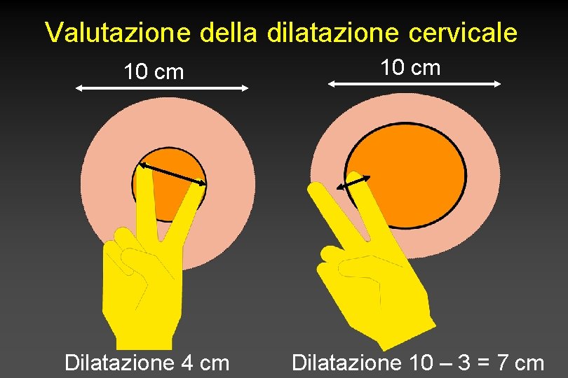 Valutazione della dilatazione cervicale 10 cm Dilatazione 4 cm 10 cm Dilatazione 10 –