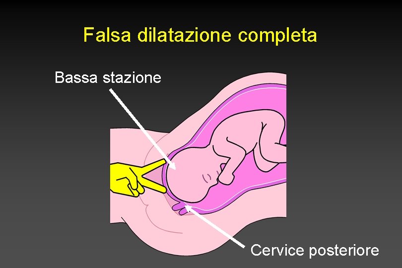 Falsa dilatazione completa Bassa stazione Cervice posteriore 