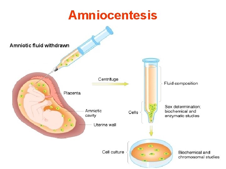 Amniocentesis Amniotic fluid withdrawn 