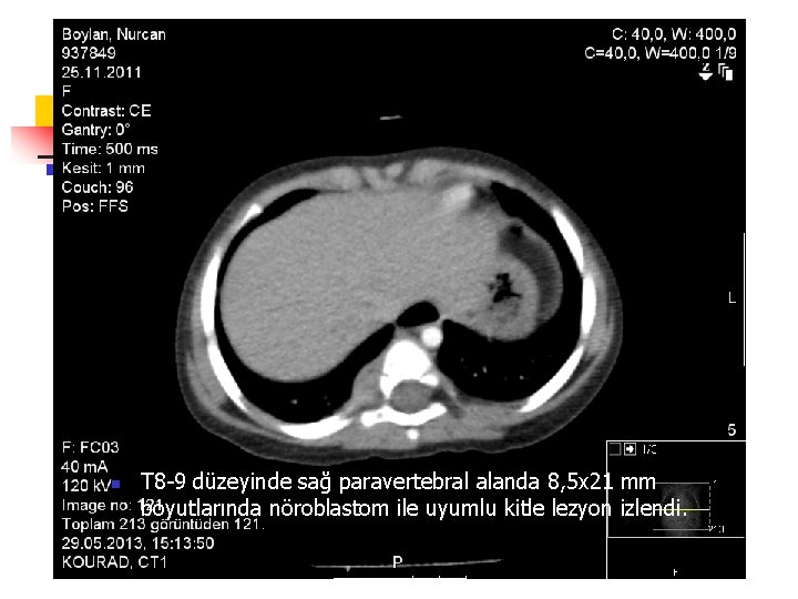 n T 8 -9 düzeyinde sağ paravertebral alanda 8, 5 x 21 mm boyutlarında