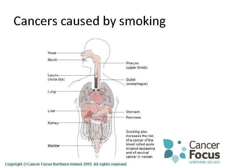 Cancers caused by smoking Copyright © Cancer Focus Northern Ireland 2015 All rights reserved