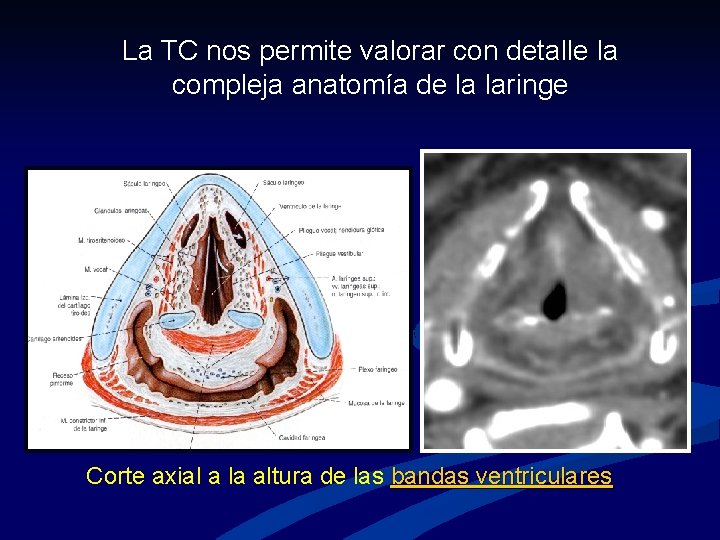 La TC nos permite valorar con detalle la compleja anatomía de la laringe Corte