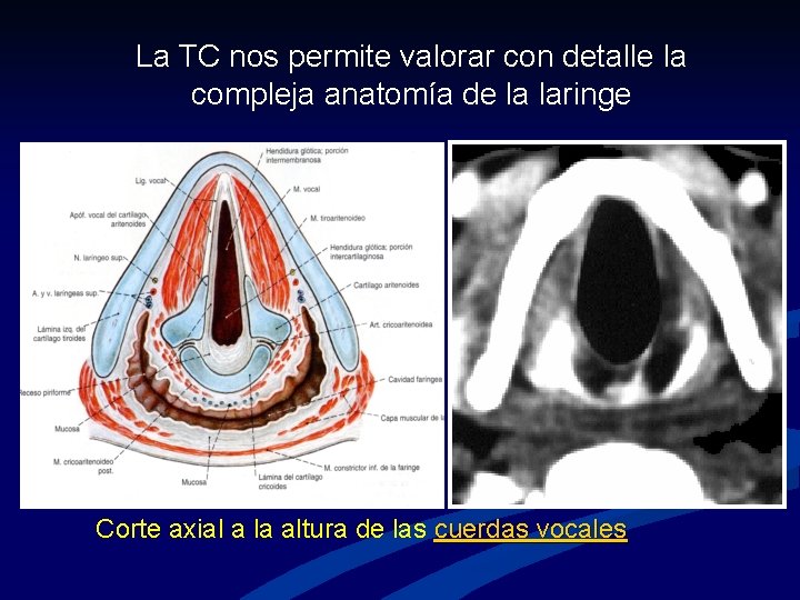 La TC nos permite valorar con detalle la compleja anatomía de la laringe Corte