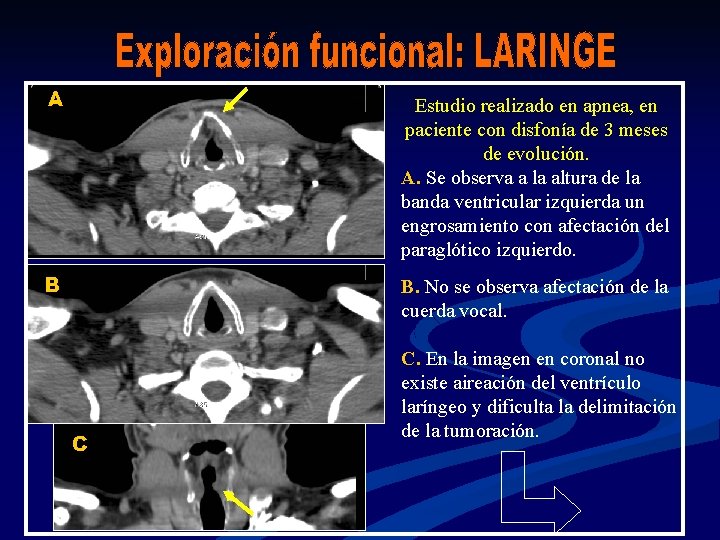 A Estudio realizado en apnea, en paciente con disfonía de 3 meses de evolución.