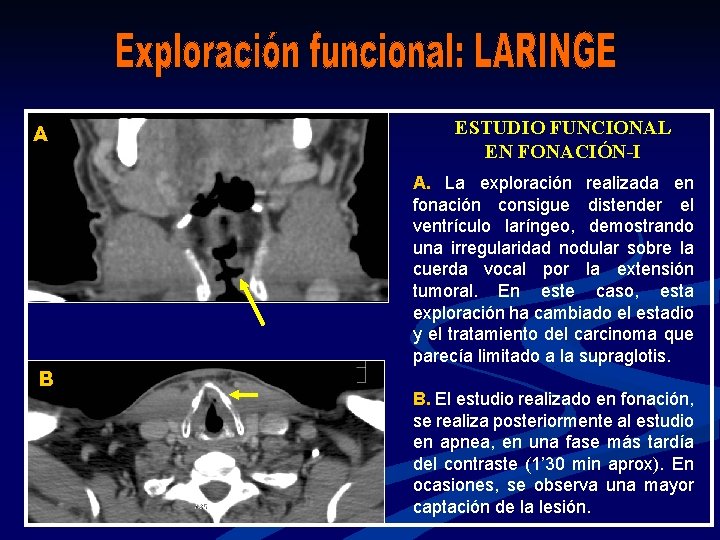 A B ESTUDIO FUNCIONAL EN FONACIÓN-I A. La exploración realizada en fonación consigue distender