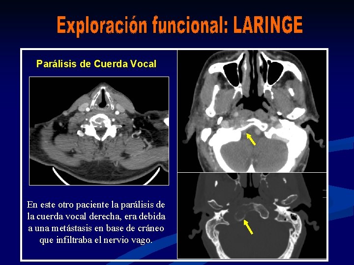 Parálisis de Cuerda Vocal En este otro paciente la parálisis de la cuerda vocal