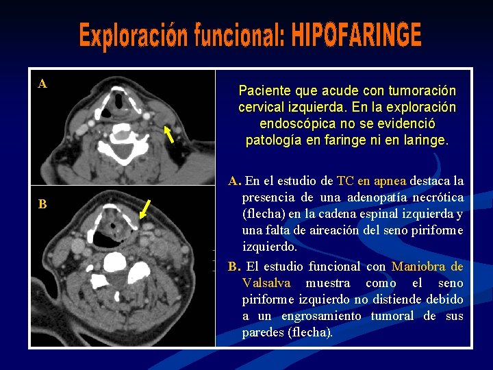 A B Paciente que acude con tumoración cervical izquierda. En la exploración endoscópica no