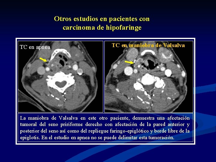 Otros estudios en pacientes con carcinoma de hipofaringe TC en apnea TC en maniobra