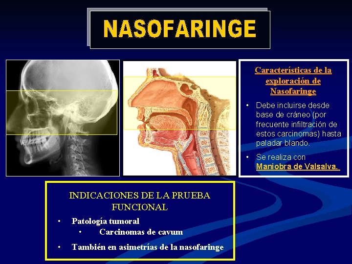 Características de la exploración de Nasofaringe • Debe incluirse desde base de cráneo (por